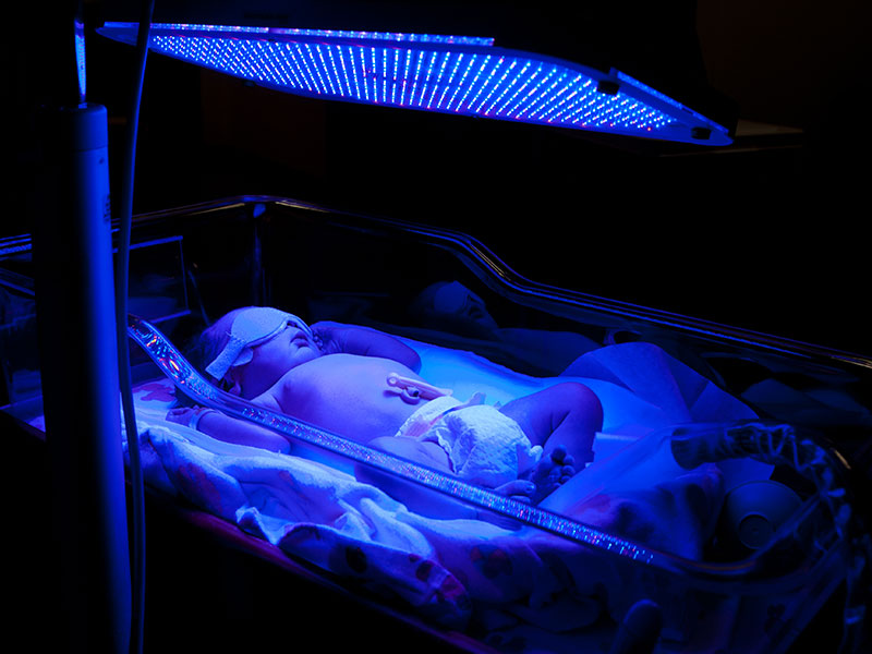 درمان زردی نوزاد به روش فتوتراپی از طریق خوابیدن در دستگاه زردی نوزاد