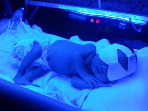 درمان کودک مبتلا به زردی از طریق فتوتراپی توسط دستگاه زردی نوزاد