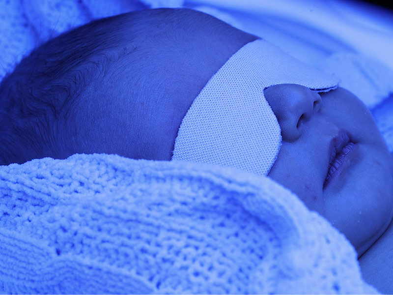 نوزاد مبتلا به زردی در حال فتوتراپی