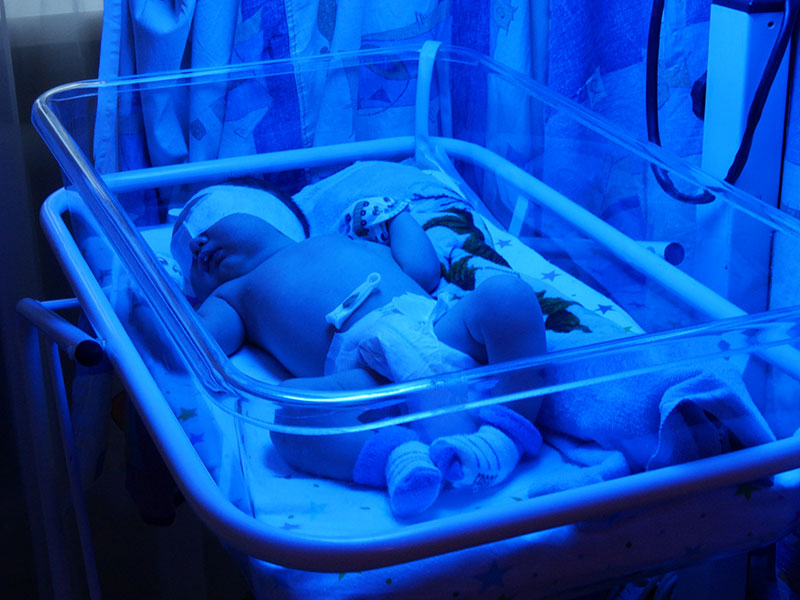 کودک مبتلا به زردی قراره داده شده در دستگاه زردی نوزاد