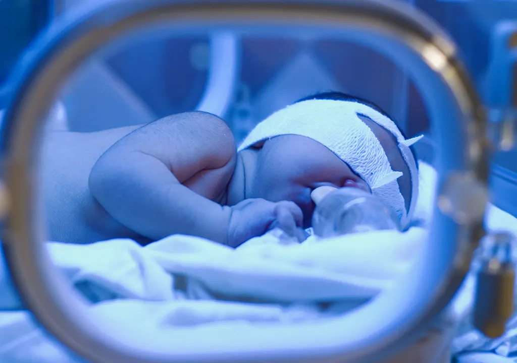 تصویر نوزاد داخل دستگاه فتوتراپی همراه با شیشه شیر