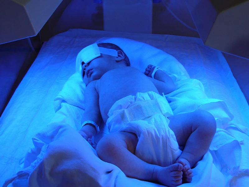 کاهش ریسک سوختن نوزاد در دستگاه فتوتراپی