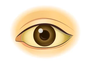 زردی چشم نوزادان به چه شکلی است
